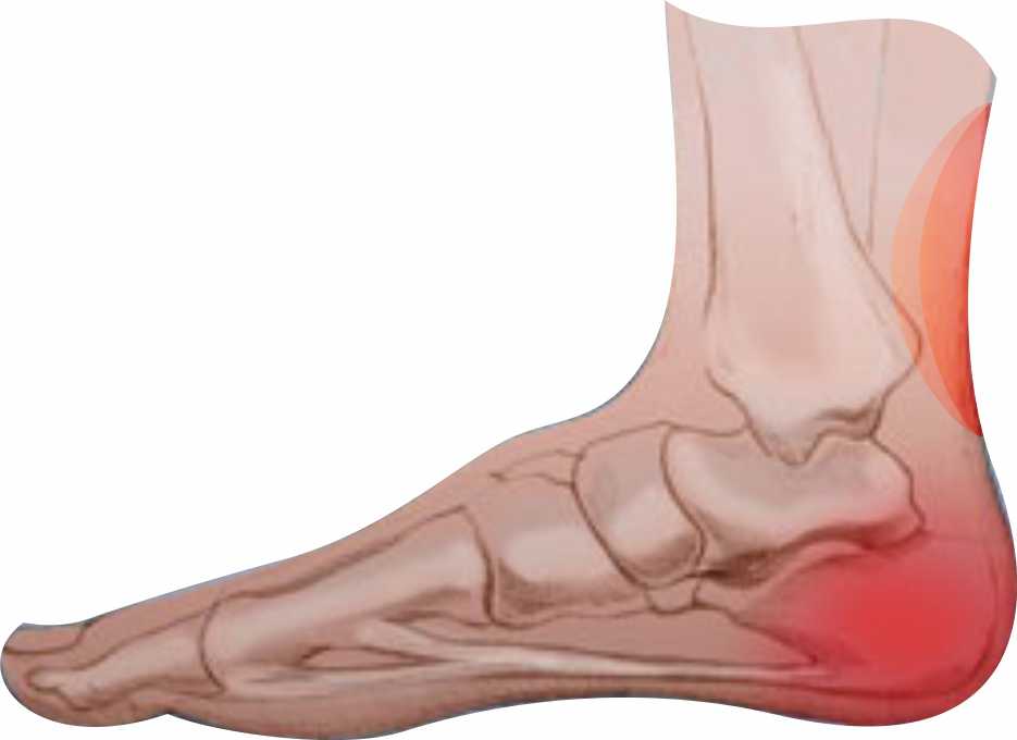 PieDolorTalonTendon
